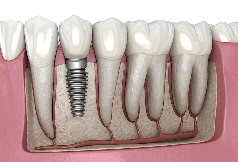 Dental Implant Costs in 2024: What to Expect-3